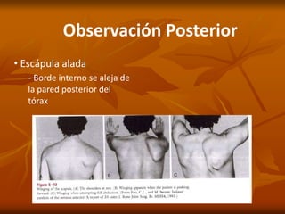 Observación Posterior
• Escápula alada
- Borde interno se aleja de
la pared posterior del
tórax
 