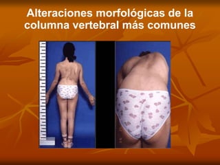 Alteraciones morfológicas de la
columna vertebral más comunes
 