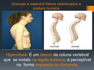 Doenças e aspectos físicos relacionados a
postura humana
Hipercifose: É um desvio da coluna vertebral
que se instala na região torácica, é perceptível
na forma arqueada ou corcunda.
 