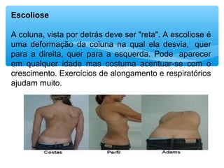 Escoliose
A coluna, vista por detrás deve ser "reta". A escoliose é 
uma  deformação  da  coluna  na  qual  ela  desvia,   quer 
para  a  direita,  quer  para  a  esquerda.  Pode   aparecer 
em  qualquer  idade  mas  costuma  acentuar-se  com  o 
crescimento. Exercícios de alongamento e respiratórios 
ajudam muito. 
 