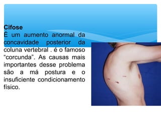 Cifose
É  um  aumento  anormal  da 
concavidade  posterior  da 
coluna vertebral . é o famoso 
“corcunda”.  As  causas  mais 
importantes  desse  problema 
são  a  má  postura  e  o 
insuficiente  condicionamento 
físico. 
 