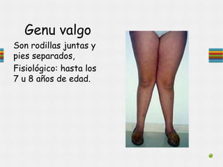 Genu valgo
Son rodillas juntas y
pies separados,
Fisiológico: hasta los
7 u 8 años de edad.
 