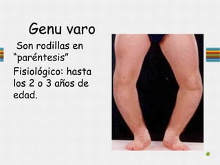 Genu varo
Son rodillas en
“paréntesis”
Fisiológico: hasta
los 2 o 3 años de
edad.
 