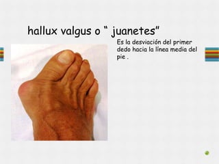 hallux valgus o “ juanetes”
Es la desviación del primer
dedo hacia la línea media del
pie .
 