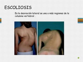 ESCOLIOSIS
Es la desviación lateral se una o más regiones de la
columna vertebral .
 