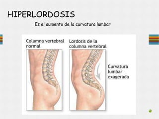 HIPERLORDOSIS
Es el aumento de la curvatura lumbar
 
