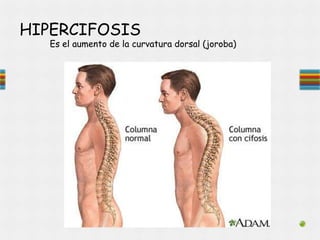 HIPERCIFOSIS
Es el aumento de la curvatura dorsal (joroba)
 