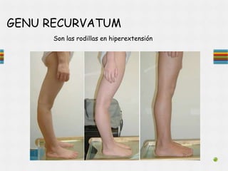 GENU RECURVATUM
Son las rodillas en hiperextensión
 