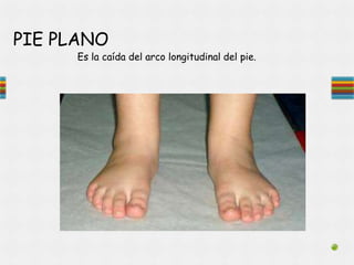 PIE PLANO
Es la caída del arco longitudinal del pie.
 
