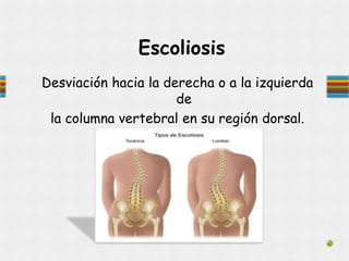 Escoliosis
Desviación hacia la derecha o a la izquierda
de
la columna vertebral en su región dorsal.
 