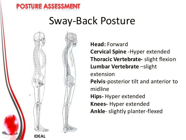 Forward Pelvic Tilt Posture