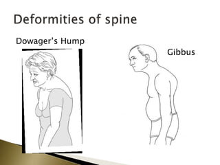 Dowager’s Hump
Gibbus
 