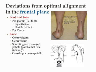  Foot and toes
◦ Pes planus (flat foot)
 Rigid flat foot
 Flexible flat foot
◦ Pes Cavus
 Knee
◦ Genu valgum
◦ Genu varum
◦ Squinting or cross-eyed
patella (patella that face
medially)
◦ Grasshopper-eyes patella
 