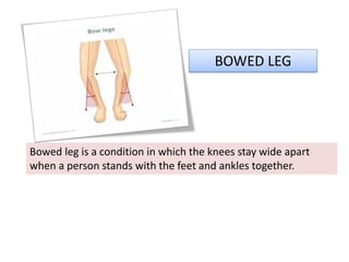 BOWED LEG
Bowed leg is a condition in which the knees stay wide apart
when a person stands with the feet and ankles together.