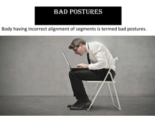 BAD POSTURES
Body having incorrect alignment of segments is termed bad postures.
 