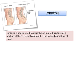 LORDOSIS
Lordosis is a term used to describe an injured fracture of a
portion of the vertebral column.It is the inward curvature of
spine.