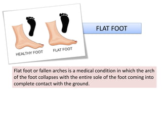 FLAT FOOT
Flat foot or fallen arches is a medical condition in which the arch
of the foot collapses with the entire sole of the foot coming into
complete contact with the ground.