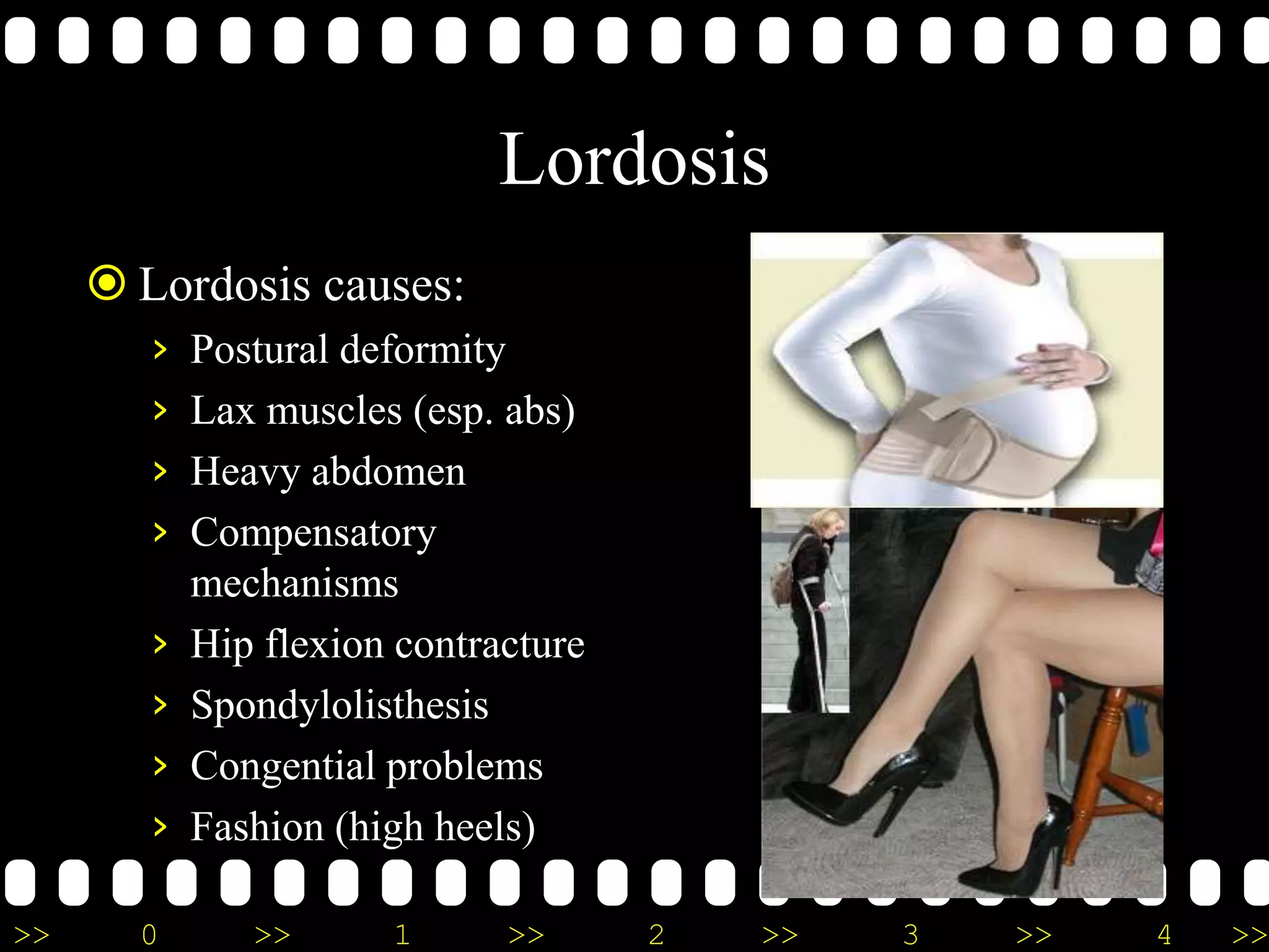 >> 0 >> 1 >> 2 >> 3 >> 4 >>
Lordosis
 Lordosis causes:
› Postural deformity
› Lax muscles (esp. abs)
› Heavy abdomen
› Compensatory
mechanisms
› Hip flexion contracture
› Spondylolisthesis
› Congential problems
› Fashion (high heels)
 