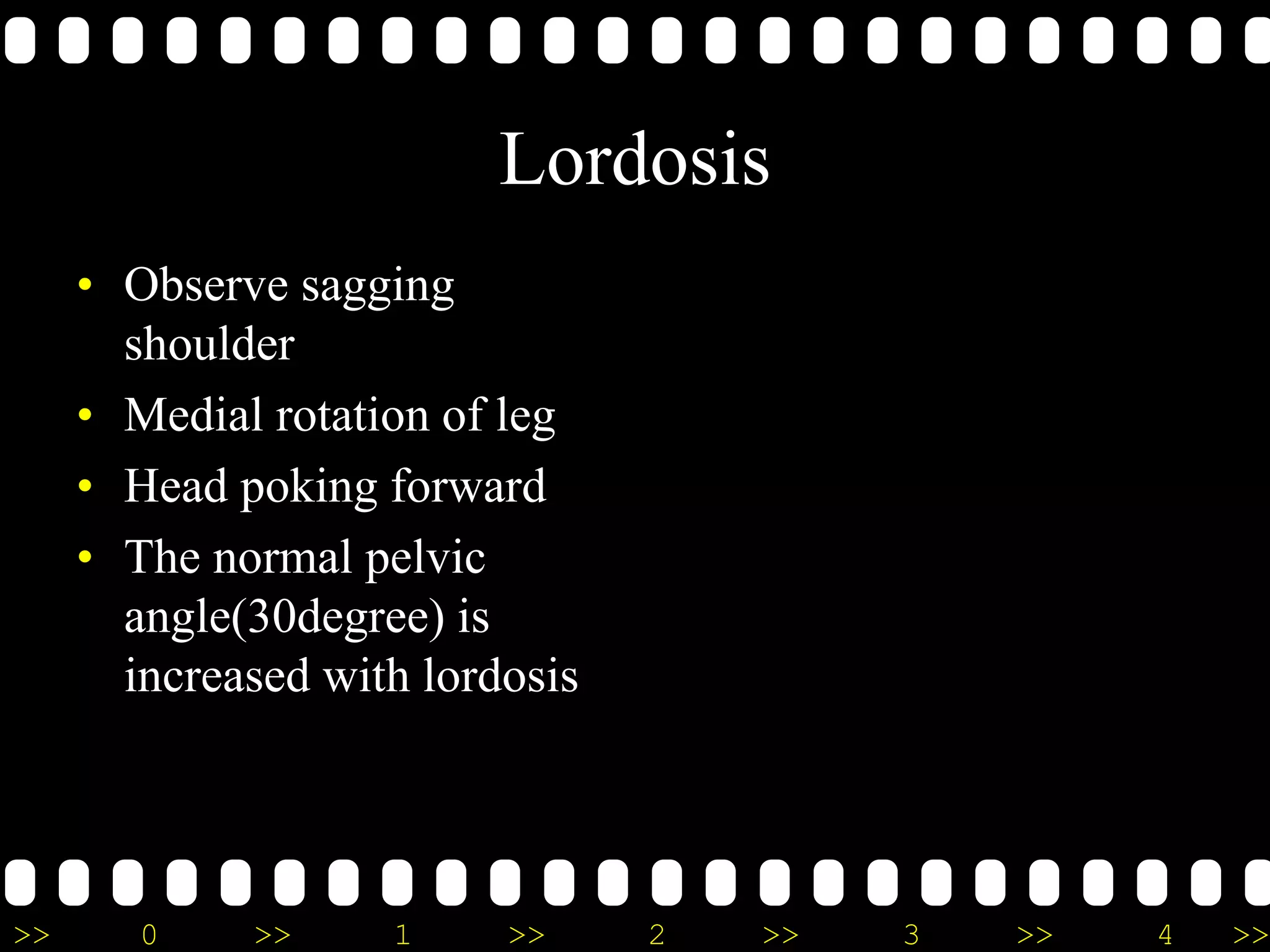 >> 0 >> 1 >> 2 >> 3 >> 4 >>
Lordosis
• Observe sagging
shoulder
• Medial rotation of leg
• Head poking forward
• The normal pelvic
angle(30degree) is
increased with lordosis
 