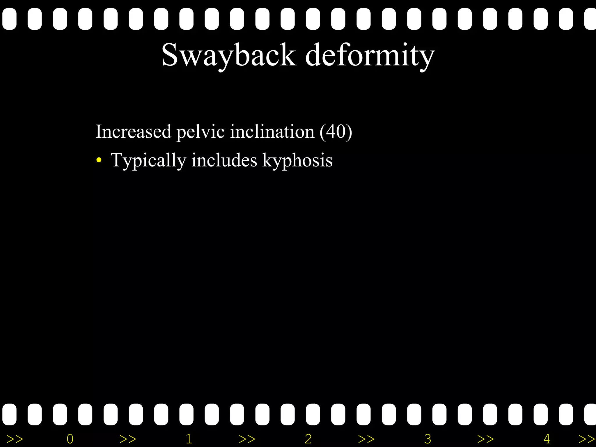 >> 0 >> 1 >> 2 >> 3 >> 4 >>
Swayback deformity
Increased pelvic inclination (40)
• Typically includes kyphosis
 
