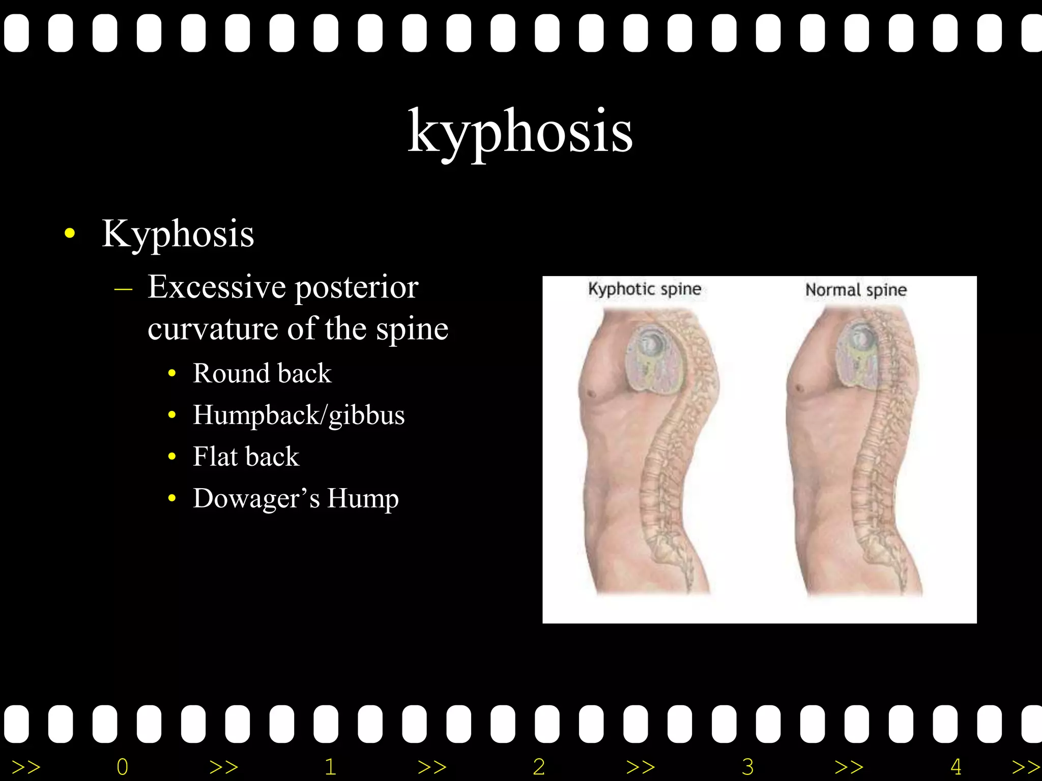>> 0 >> 1 >> 2 >> 3 >> 4 >>
kyphosis
• Kyphosis
– Excessive posterior
curvature of the spine
• Round back
• Humpback/gibbus
• Flat back
• Dowager’s Hump
 