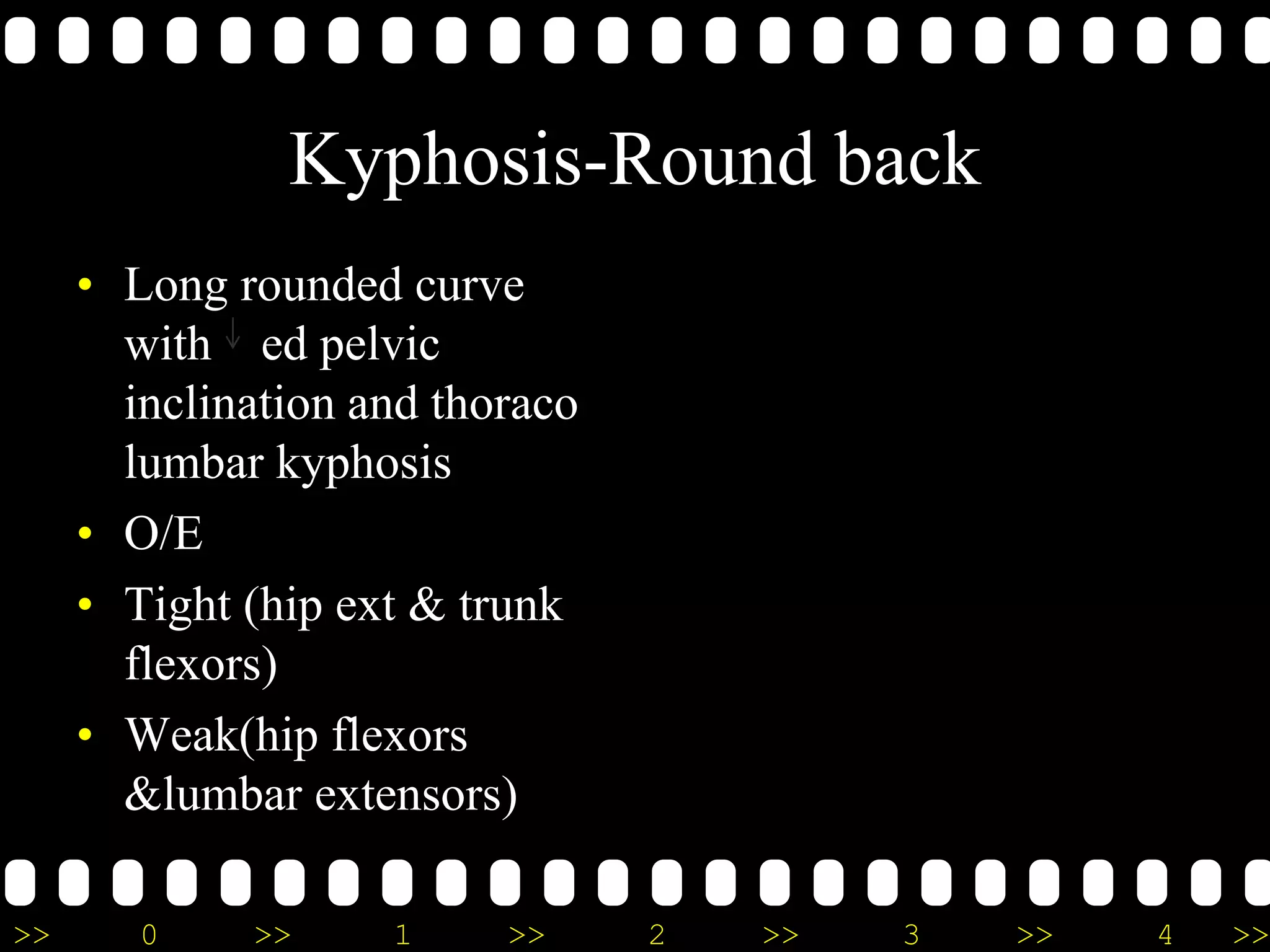 >> 0 >> 1 >> 2 >> 3 >> 4 >>
Kyphosis-Round back
• Long rounded curve
with ed pelvic
inclination and thoraco
lumbar kyphosis
• O/E
• Tight (hip ext & trunk
flexors)
• Weak(hip flexors
&lumbar extensors)
 