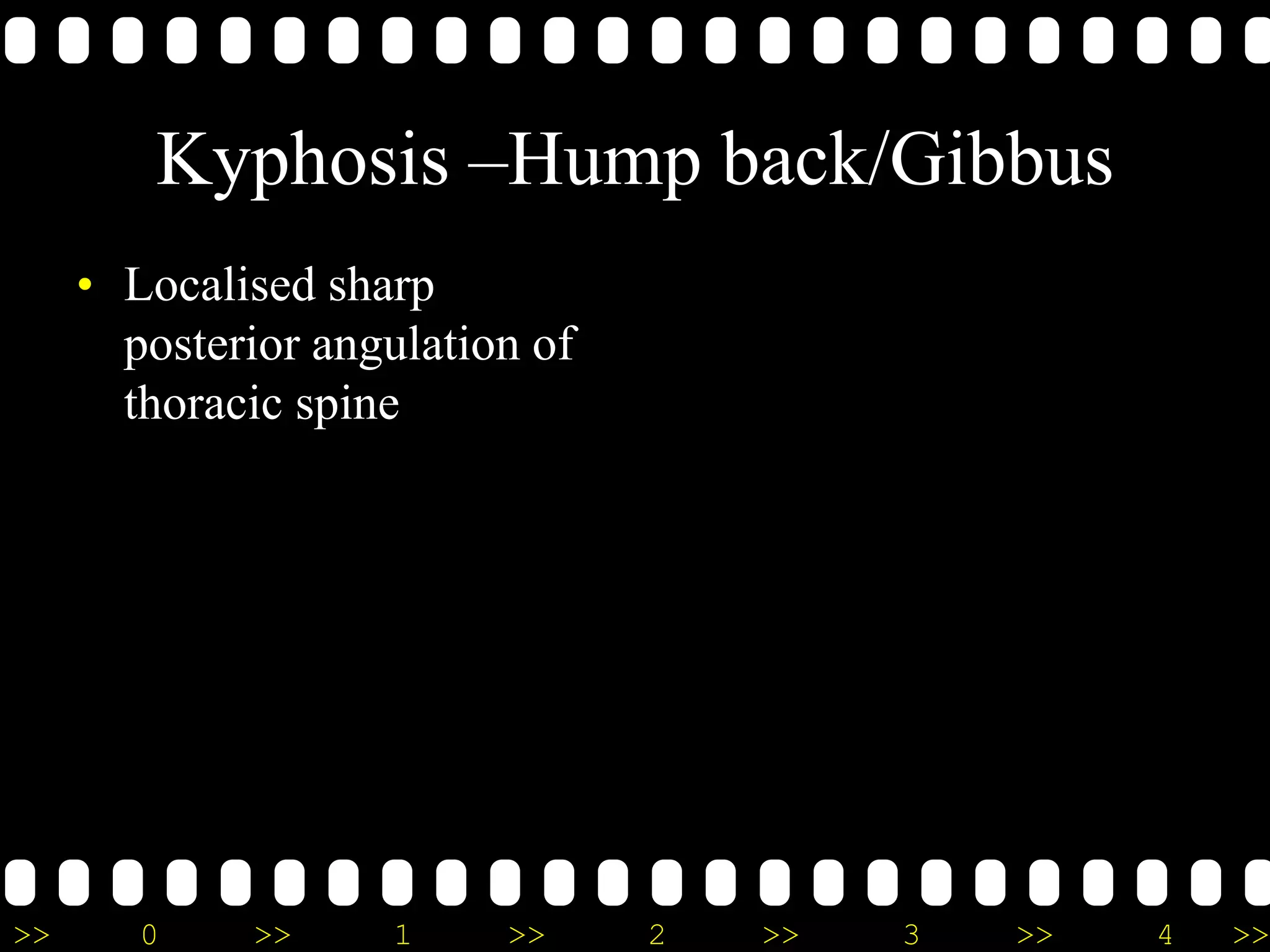>> 0 >> 1 >> 2 >> 3 >> 4 >>
Kyphosis –Hump back/Gibbus
• Localised sharp
posterior angulation of
thoracic spine
 