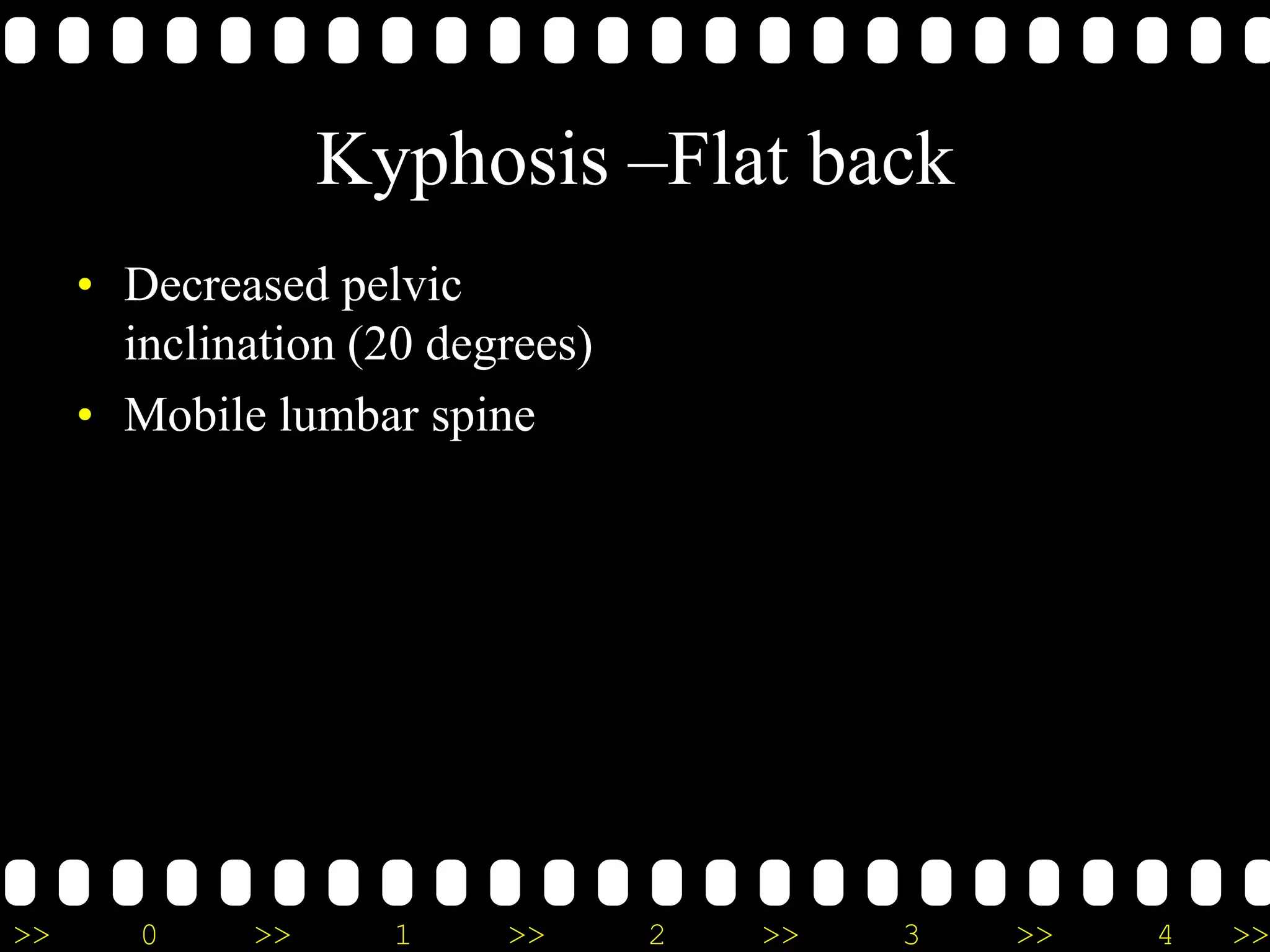 >> 0 >> 1 >> 2 >> 3 >> 4 >>
Kyphosis –Flat back
• Decreased pelvic
inclination (20 degrees)
• Mobile lumbar spine
 