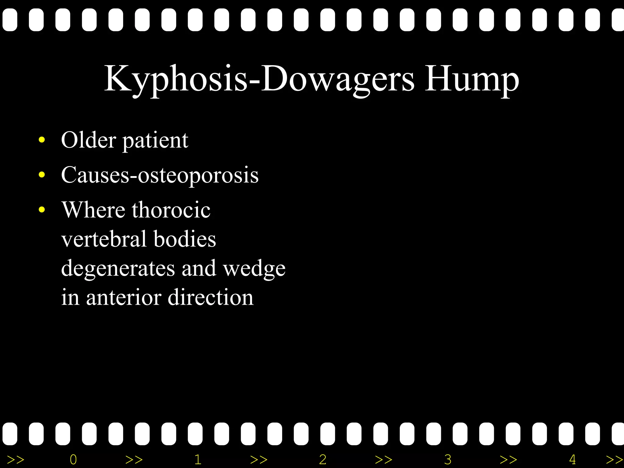 >> 0 >> 1 >> 2 >> 3 >> 4 >>
Kyphosis-Dowagers Hump
• Older patient
• Causes-osteoporosis
• Where thorocic
vertebral bodies
degenerates and wedge
in anterior direction
 