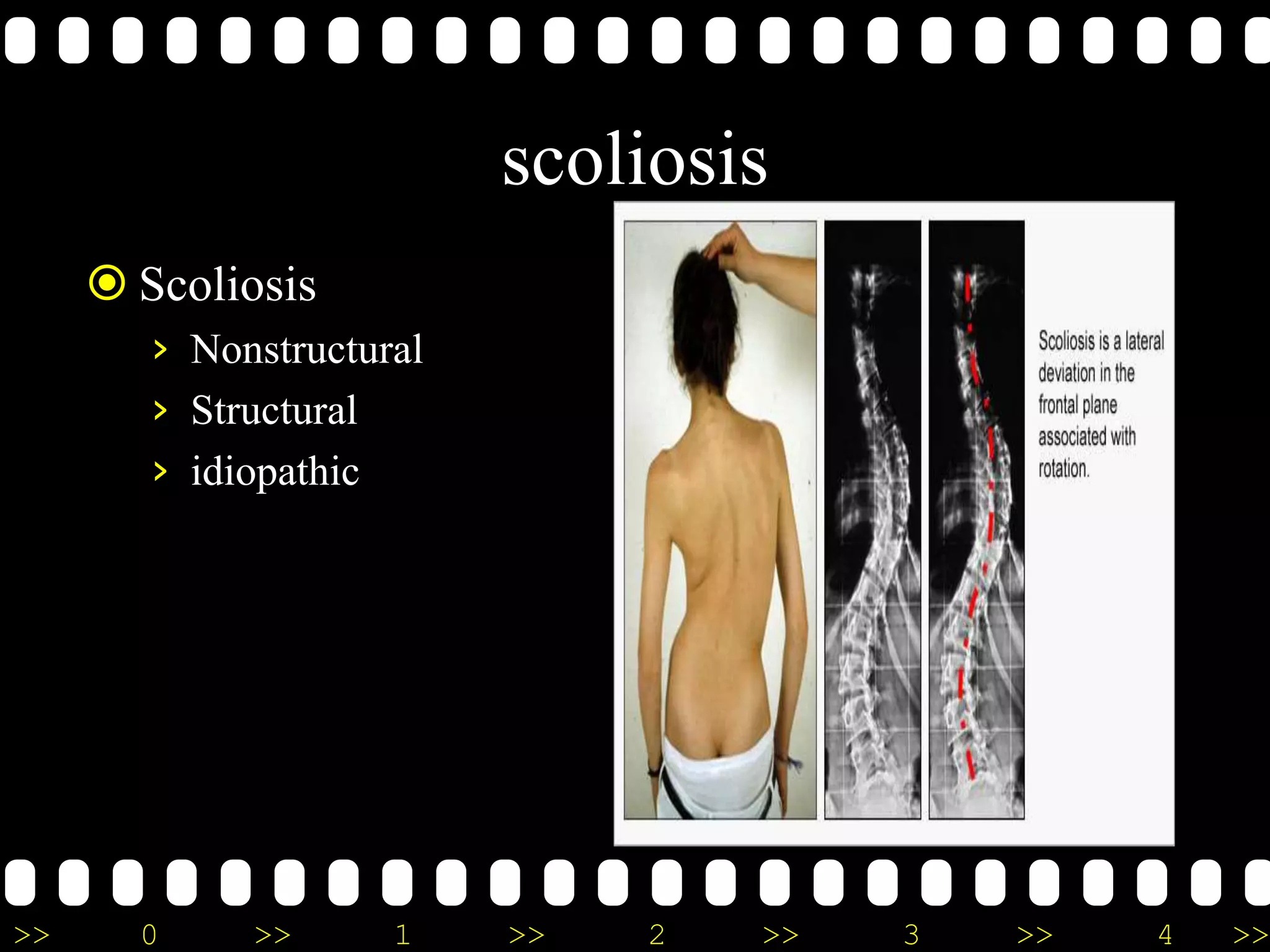 >> 0 >> 1 >> 2 >> 3 >> 4 >>
scoliosis
 Scoliosis
› Nonstructural
› Structural
› idiopathic
 