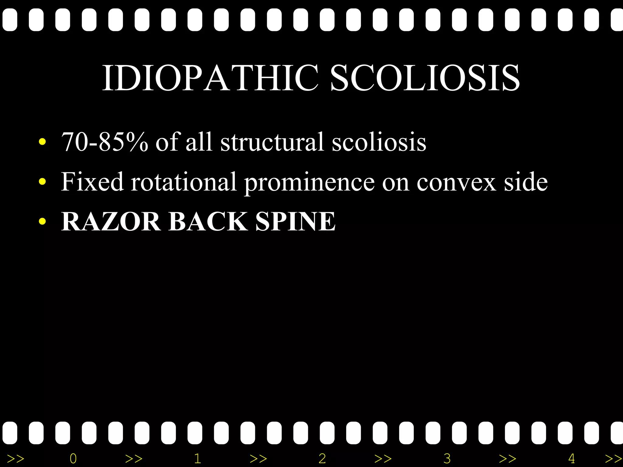 >> 0 >> 1 >> 2 >> 3 >> 4 >>
IDIOPATHIC SCOLIOSIS
• 70-85% of all structural scoliosis
• Fixed rotational prominence on convex side
• RAZOR BACK SPINE
 