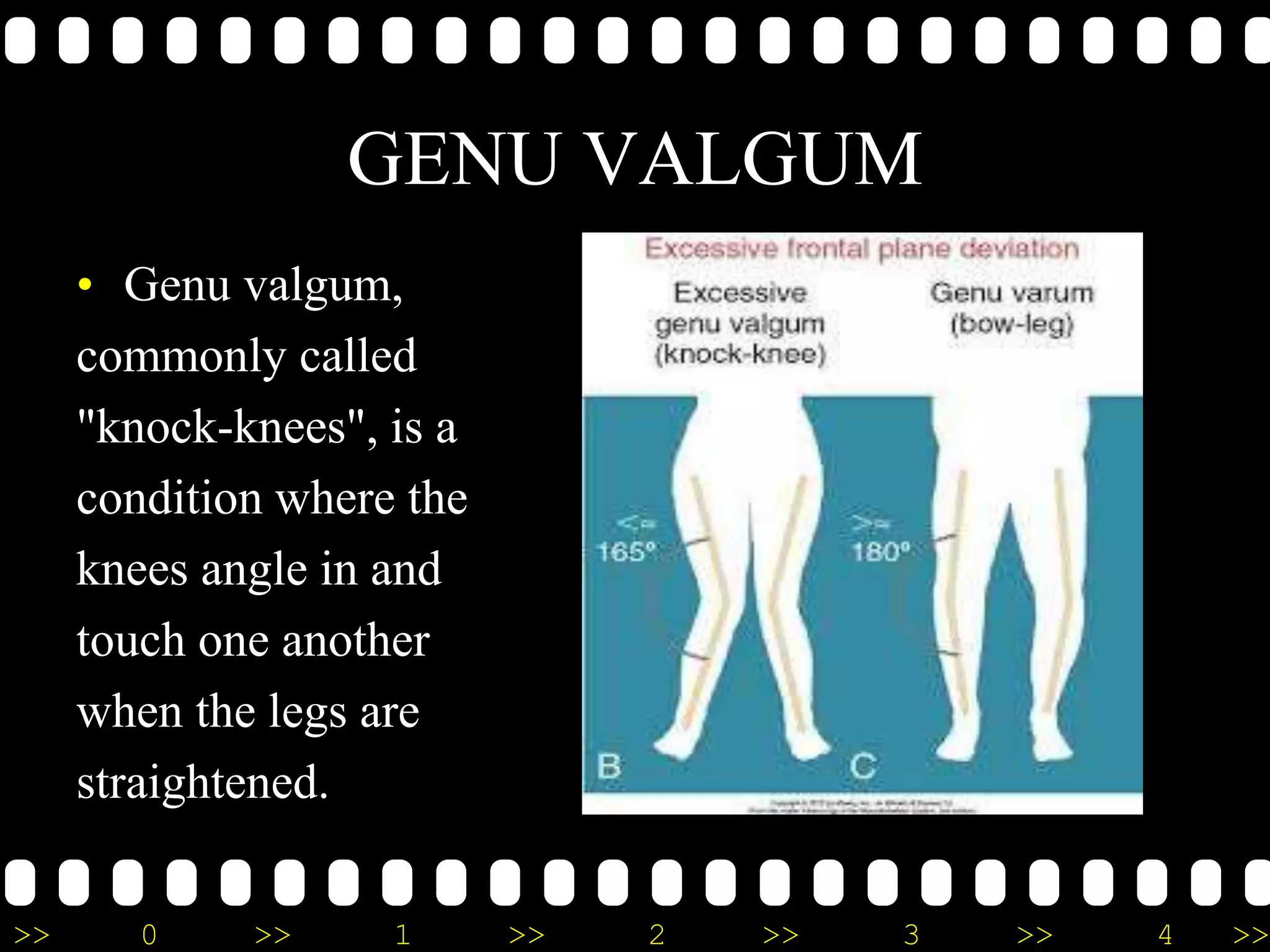 >> 0 >> 1 >> 2 >> 3 >> 4 >>
GENU VALGUM
• Genu valgum,
commonly called
"knock-knees", is a
condition where the
knees angle in and
touch one another
when the legs are
straightened.
 