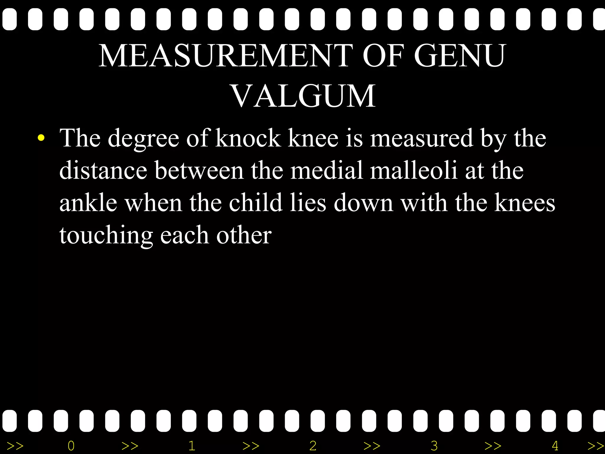 >> 0 >> 1 >> 2 >> 3 >> 4 >>
MEASUREMENT OF GENU
VALGUM
• The degree of knock knee is measured by the
distance between the medial malleoli at the
ankle when the child lies down with the knees
touching each other
 