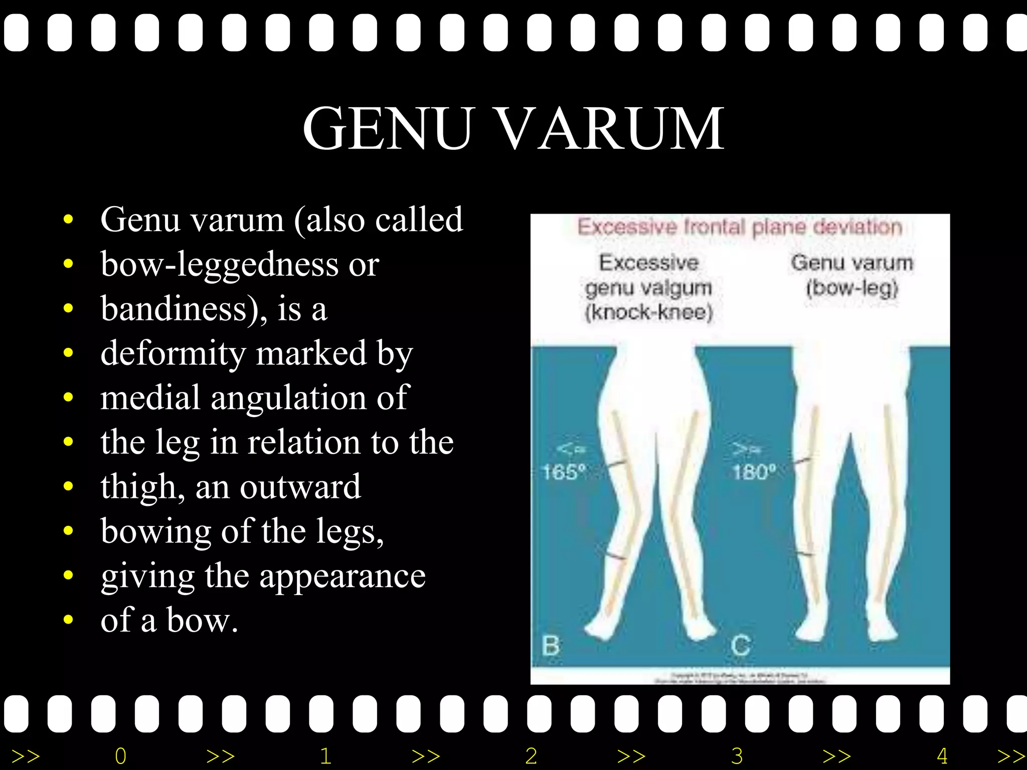 >> 0 >> 1 >> 2 >> 3 >> 4 >>
GENU VARUM
• Genu varum (also called
• bow-leggedness or
• bandiness), is a
• deformity marked by
• medial angulation of
• the leg in relation to the
• thigh, an outward
• bowing of the legs,
• giving the appearance
• of a bow.
 