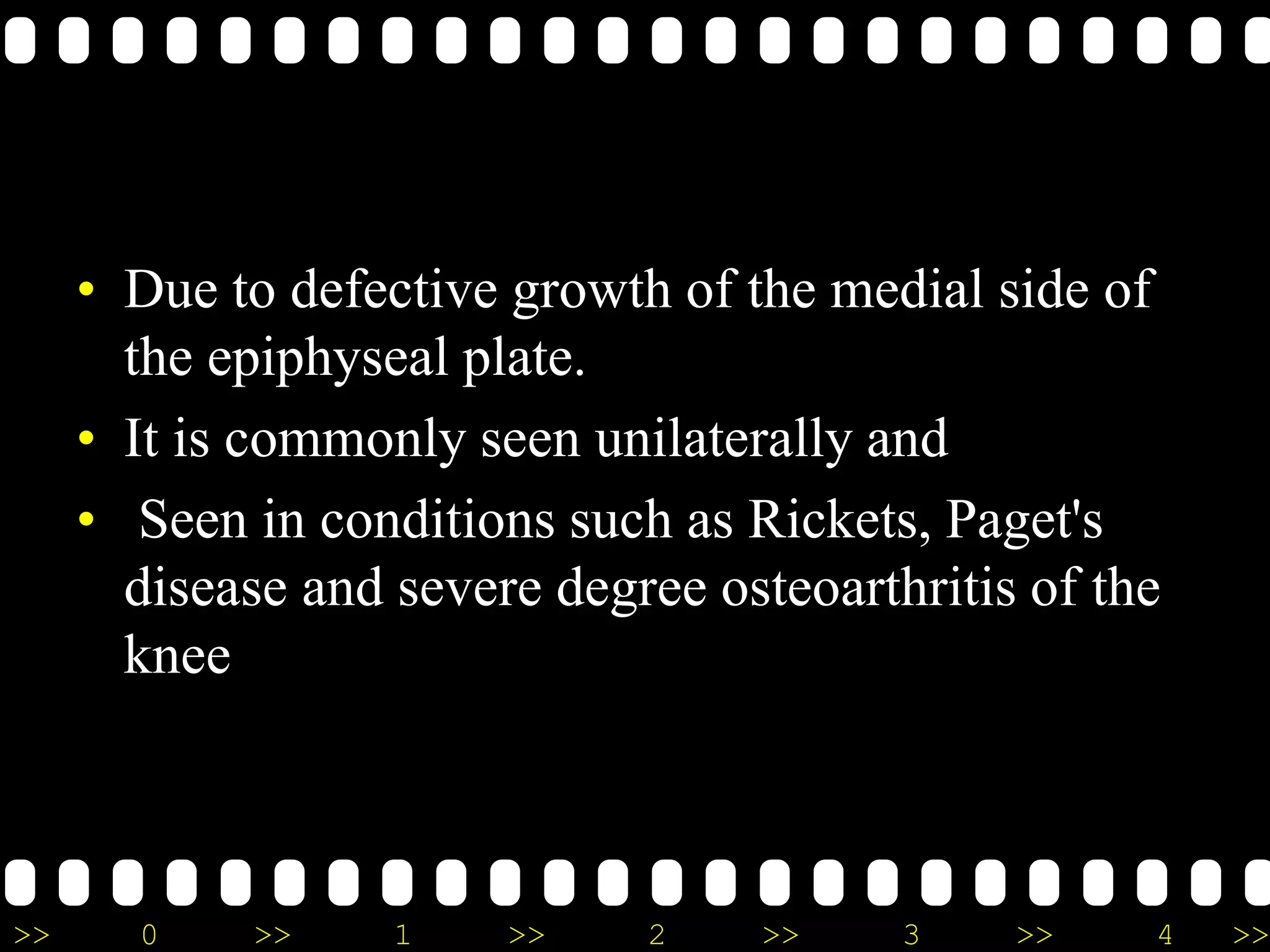 >> 0 >> 1 >> 2 >> 3 >> 4 >>
• Due to defective growth of the medial side of
the epiphyseal plate.
• It is commonly seen unilaterally and
• Seen in conditions such as Rickets, Paget's
disease and severe degree osteoarthritis of the
knee
 