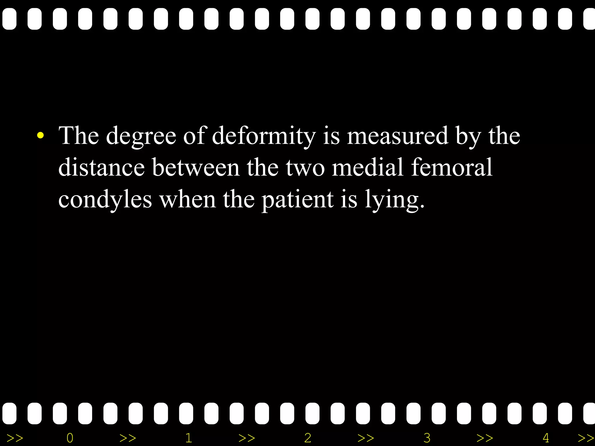 >> 0 >> 1 >> 2 >> 3 >> 4 >>
• The degree of deformity is measured by the
distance between the two medial femoral
condyles when the patient is lying.
 
