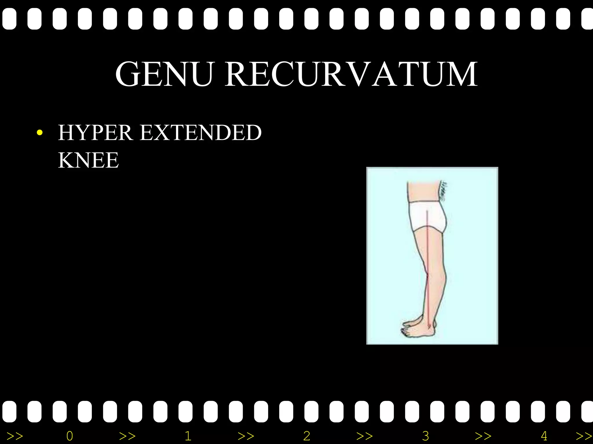 >> 0 >> 1 >> 2 >> 3 >> 4 >>
GENU RECURVATUM
• HYPER EXTENDED
KNEE
 