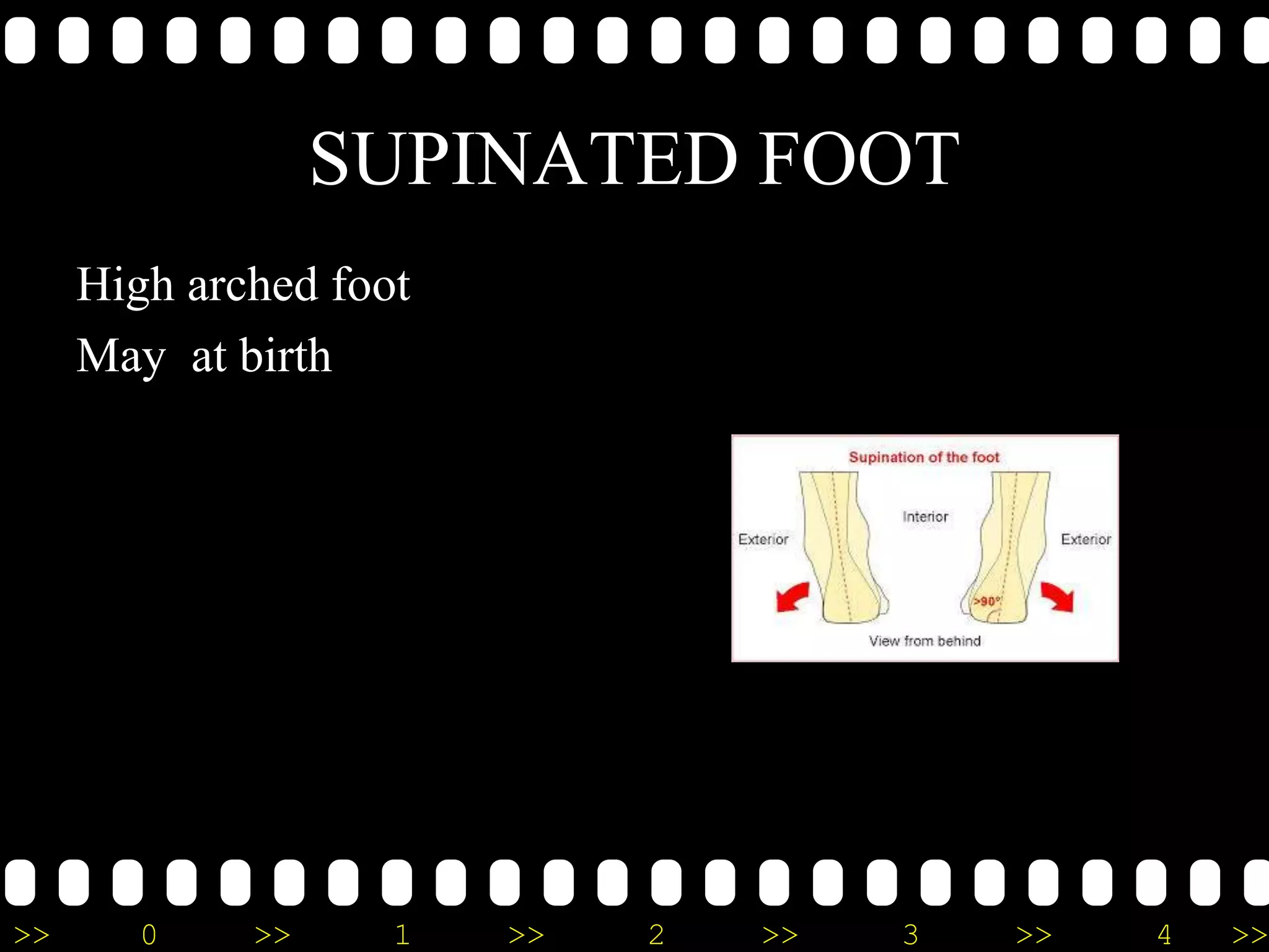 >> 0 >> 1 >> 2 >> 3 >> 4 >>
SUPINATED FOOT
High arched foot
May at birth
 