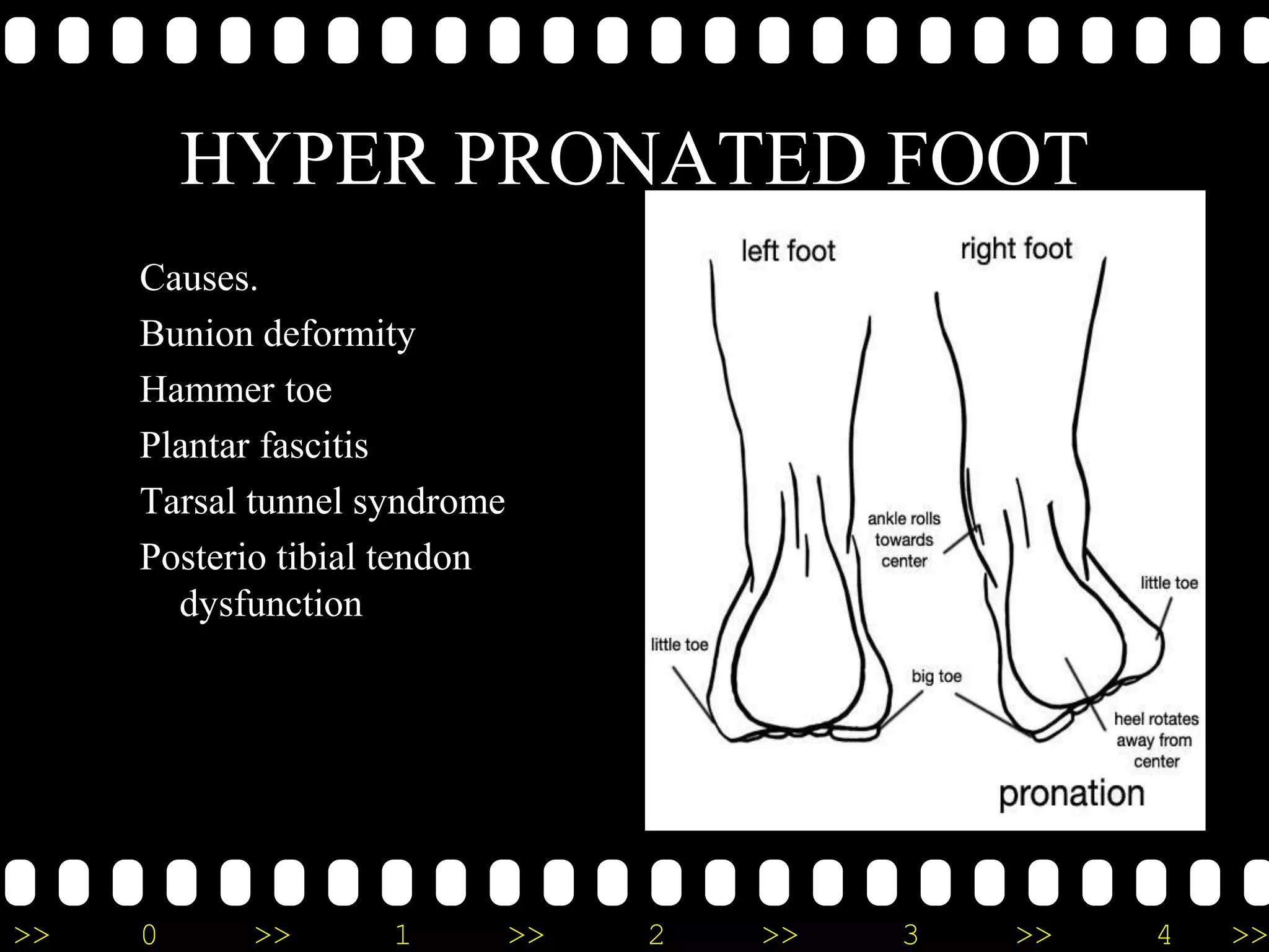 >> 0 >> 1 >> 2 >> 3 >> 4 >>
HYPER PRONATED FOOT
Causes.
Bunion deformity
Hammer toe
Plantar fascitis
Tarsal tunnel syndrome
Posterio tibial tendon
dysfunction
 