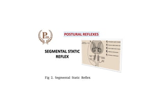 Fig 2. Segmental Static Reflex
 