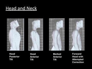 Head
Posterior
Tilt
Head
Anterior
Tilt
Marked
Anterior
Tilt
Forward
Head with
Attempted
Correction
Head and Neck
 