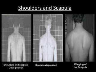 Shoulders and Scapula
Scapula depressed Winging of
the Scapula
Shoulders and scapula
Good position
 