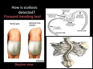 How is scoliosis
detected?
Forward bending test
Skyline view
 