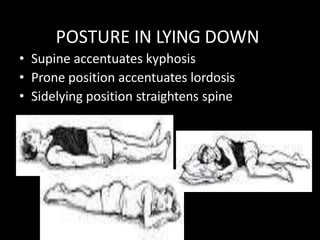 POSTURE IN LYING DOWN
• Supine accentuates kyphosis
• Prone position accentuates lordosis
• Sidelying position straightens spine
 