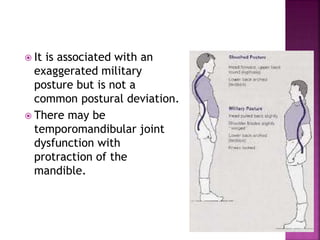  It is associated with an
exaggerated military
posture but is not a
common postural deviation.
 There may be
temporomandibular joint
dysfunction with
protraction of the
mandible.
 