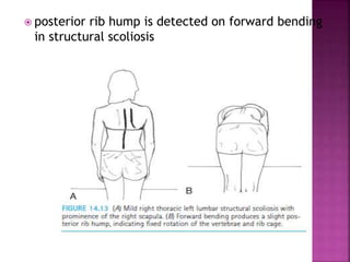  posterior rib hump is detected on forward bending
in structural scoliosis
 