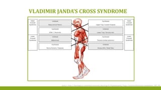VLADIMIR JANDA’S CROSS SYNDROME
Janda V, Kraus J. Neurologie pro rehabilitacni pracovniky [Neurology for Physiotherapists]. Prague: Avicenumzdravotnicke nakladatelstvi, 1987:126
 