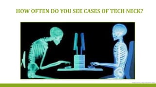 HOW OFTEN DO YOU SEE CASES OF TECH NECK?
Image source: http://erikdalton.com/
 