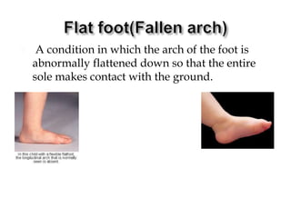  A condition in which the arch of the foot is
abnormally flattened down so that the entire
sole makes contact with the ground.
 