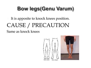  It is apposite to knock knees position.
CAUSE / PRECAUTION
Same as knock knees
 